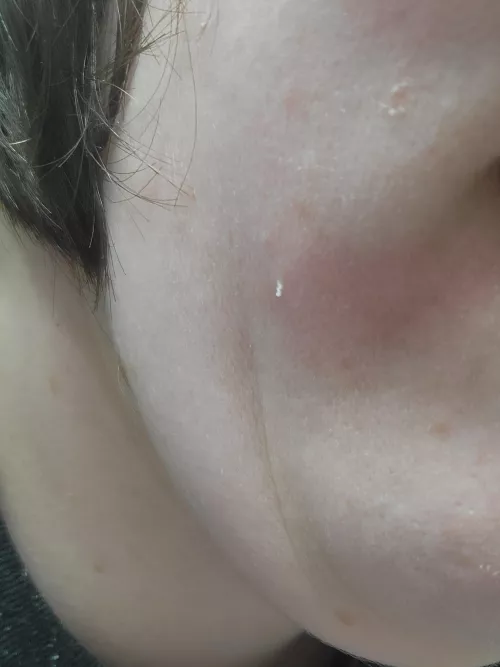 Itty bitty blackhead