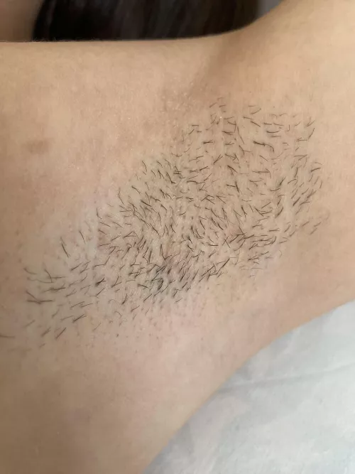 My closeup stubble pit