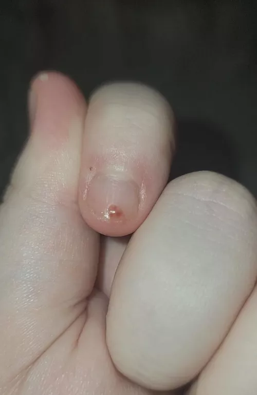 Popped a small pimple in my ear
