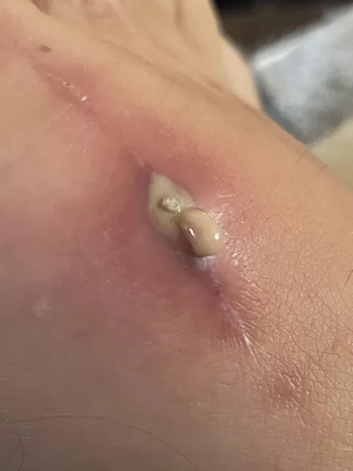 Wife’s bone growth removal site.