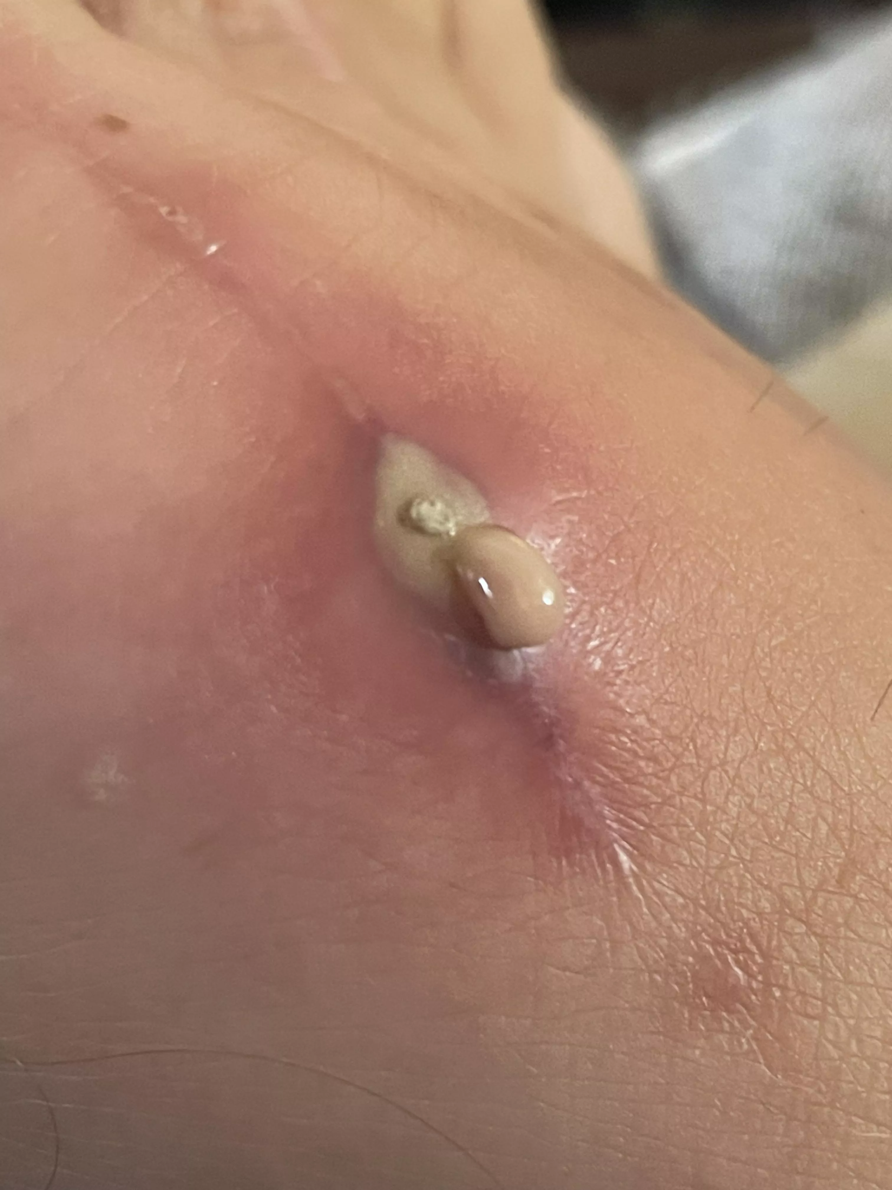 Wife’s bone growth removal site.