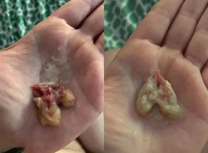 Birthed (coughed) out this mucus ball after being sick for 5 weeks and now I can BREATHE!