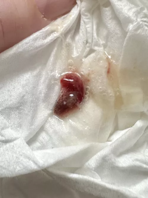 Coughed this up when I had pneumonia