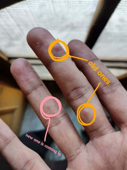 This myxoid cyst is growing