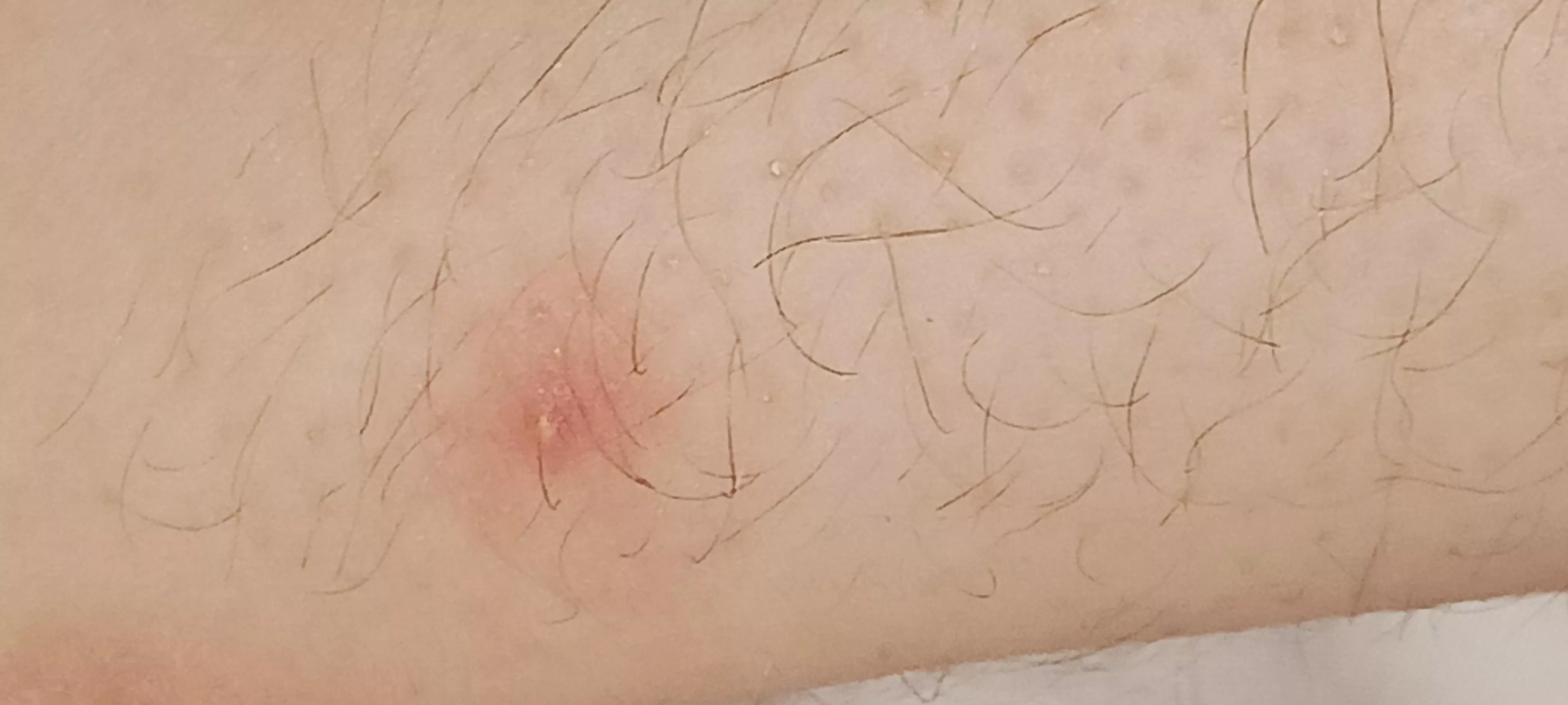 Found this very painful and annoying bump on my ankle, wondering if i should pop it.