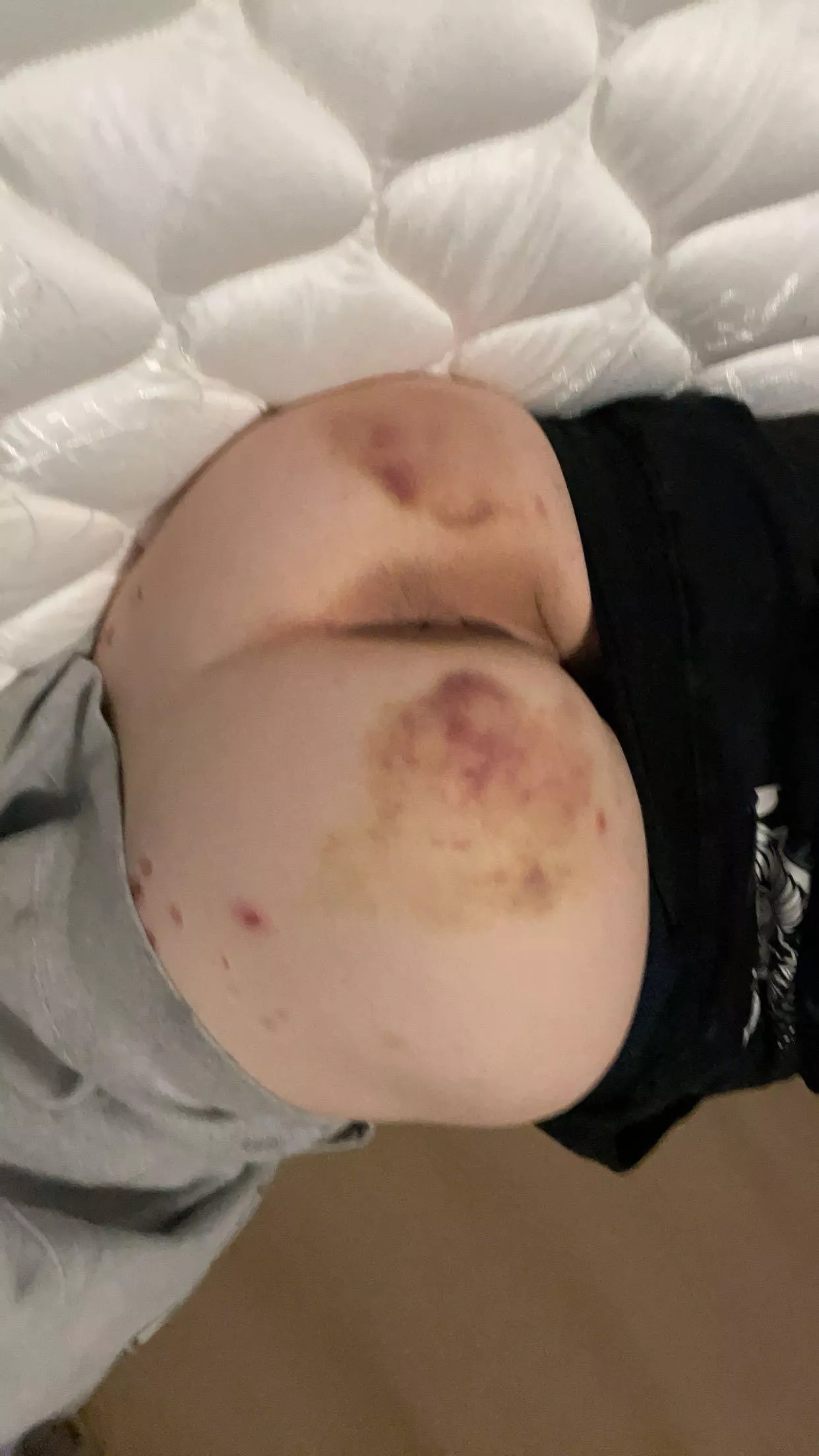 Markings update, just a few days later. Daddy kisses it every night