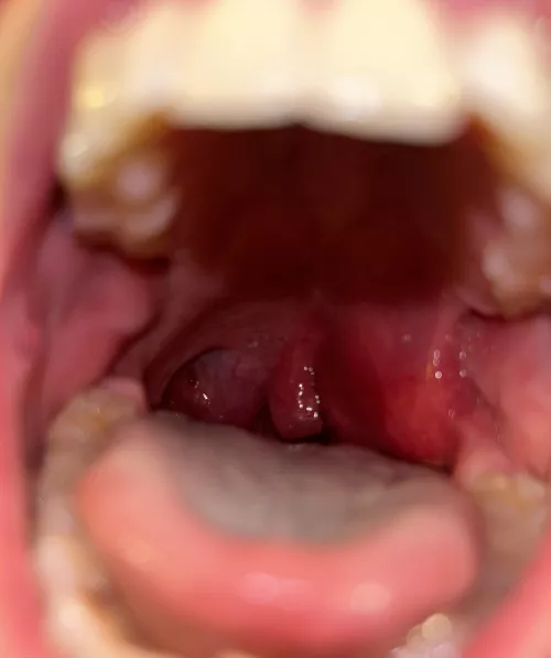 Quinsy before it burst at home. Extremely painful and scary.