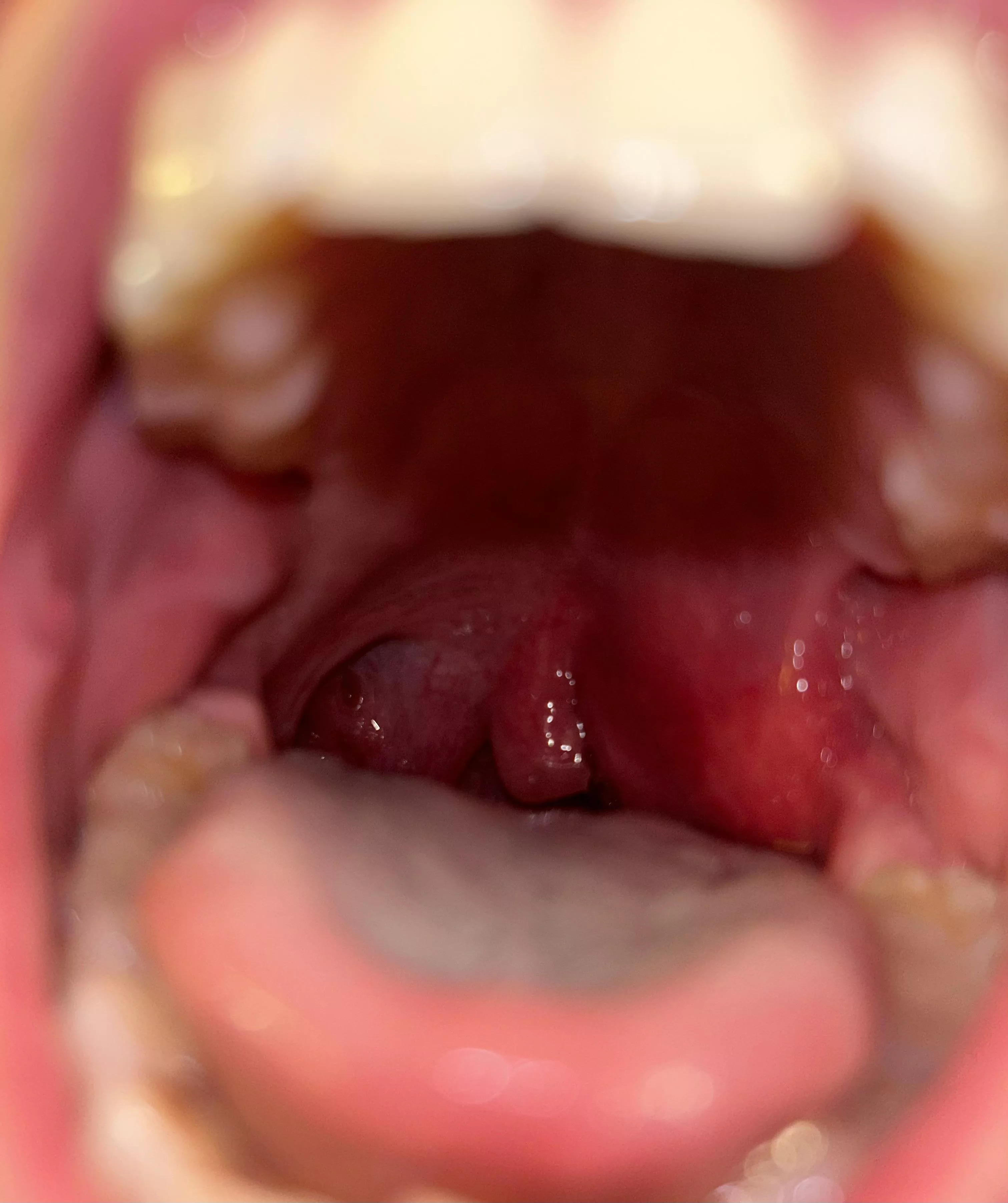 Quinsy before it burst at home. Extremely painful and scary.