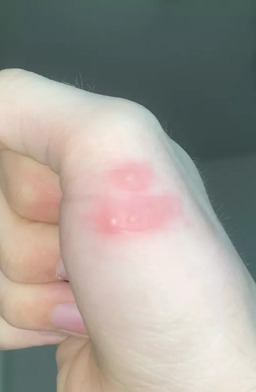 Are these pimples? Idk if they are and idk if I should pop them?