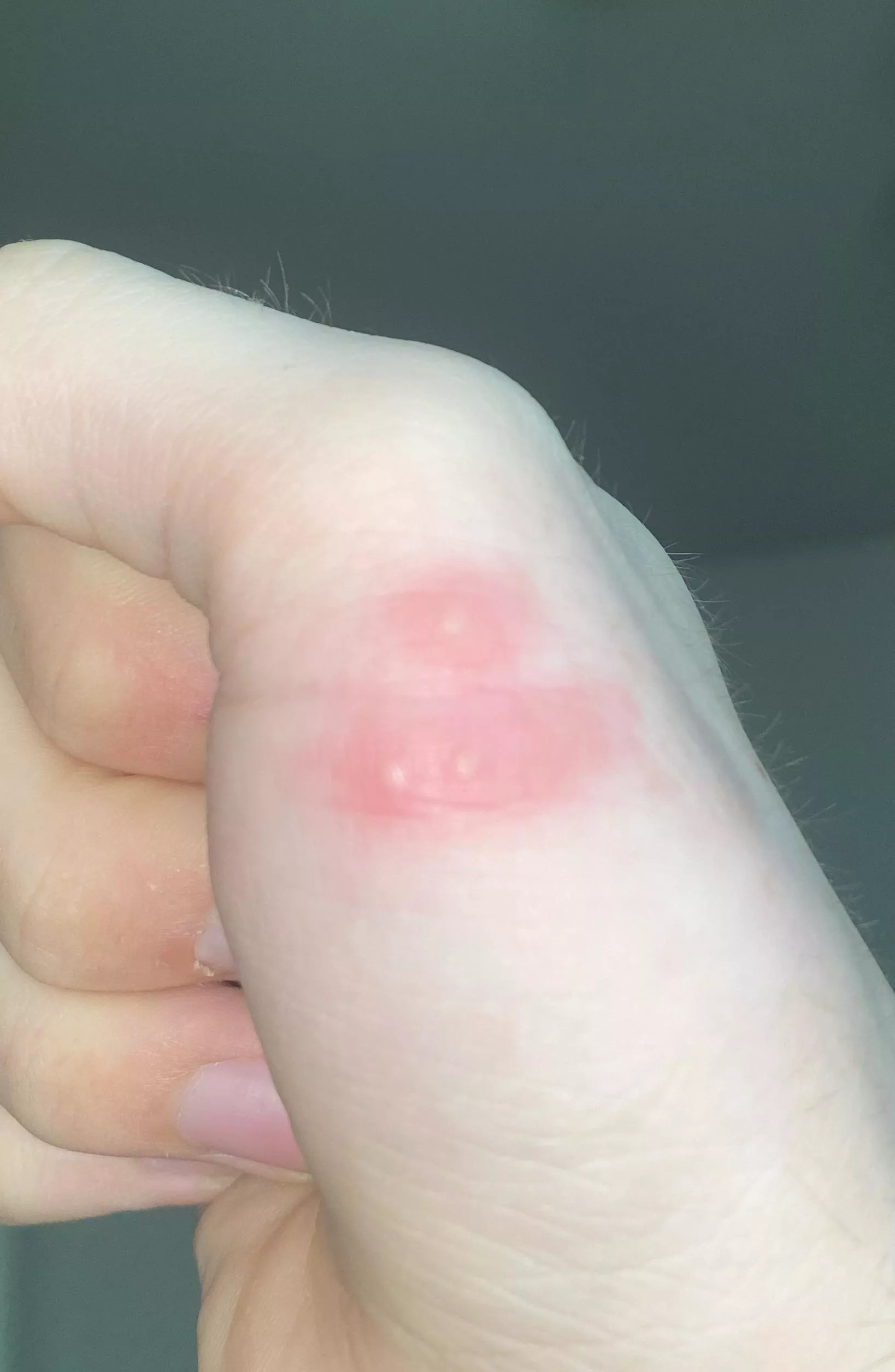 Are these pimples? Idk if they are and idk if I should pop them?