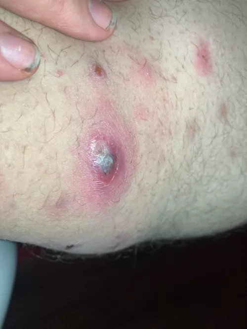 Pt3 innner thigh pimple