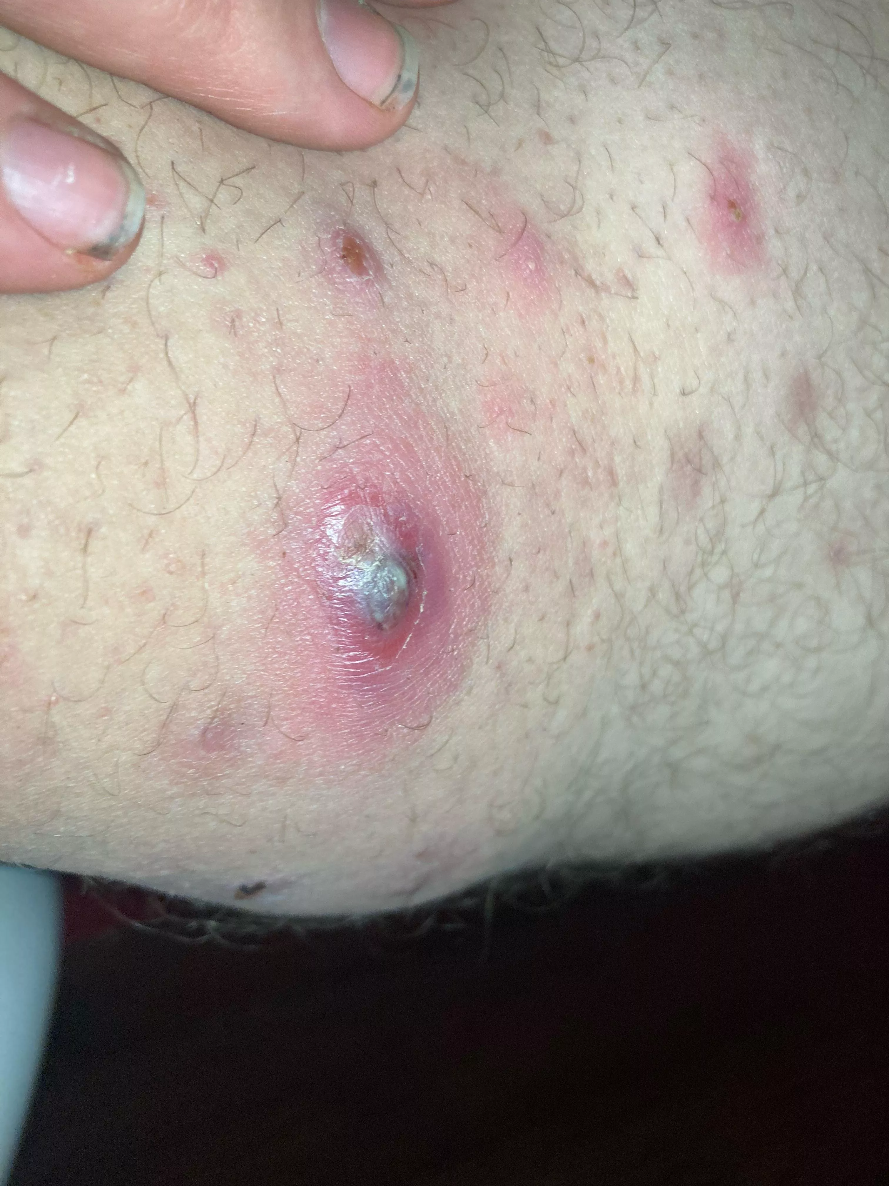 Pt3 innner thigh pimple