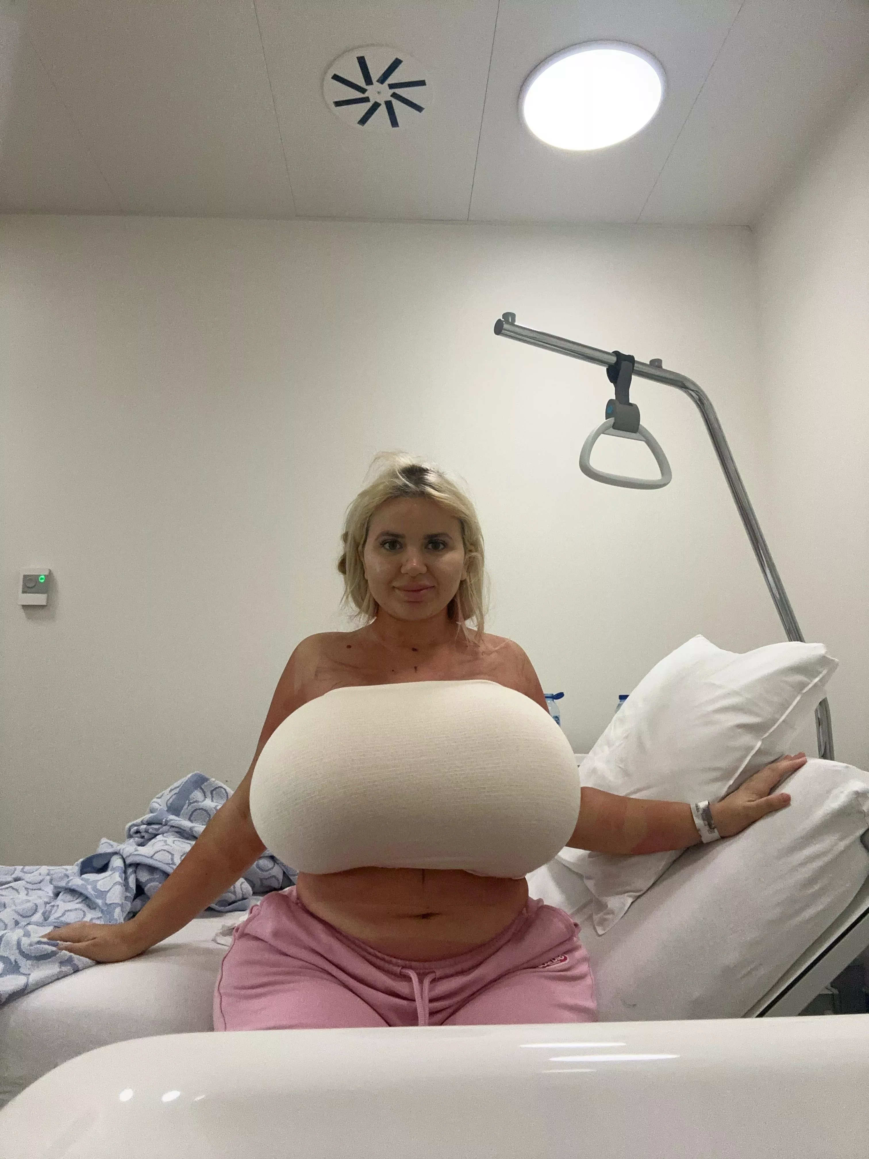 Upgraded to 3750cc today! Haven’t allowed to take the bandage off yet, but I am super exited to see them!