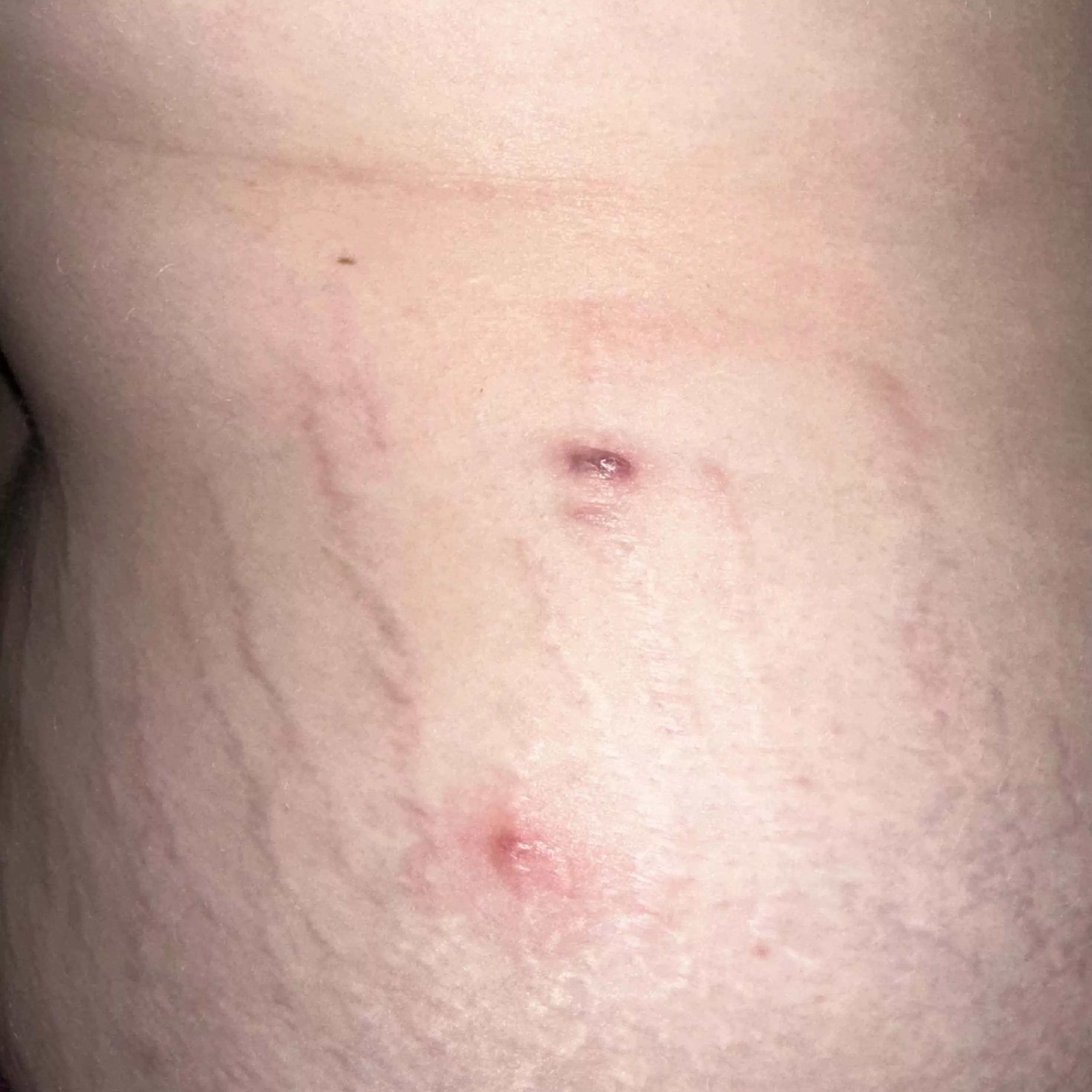Abcess, boil or cyst?