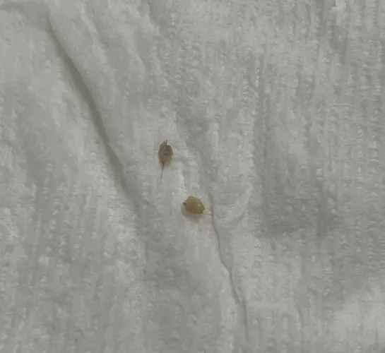 After 4 months of having these two painful small bumps on each of my buttcheeks, I am free