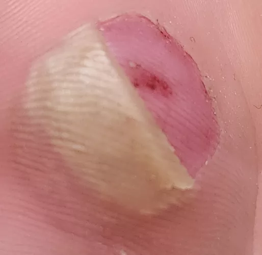 Blister skin flap is folded under the one on top