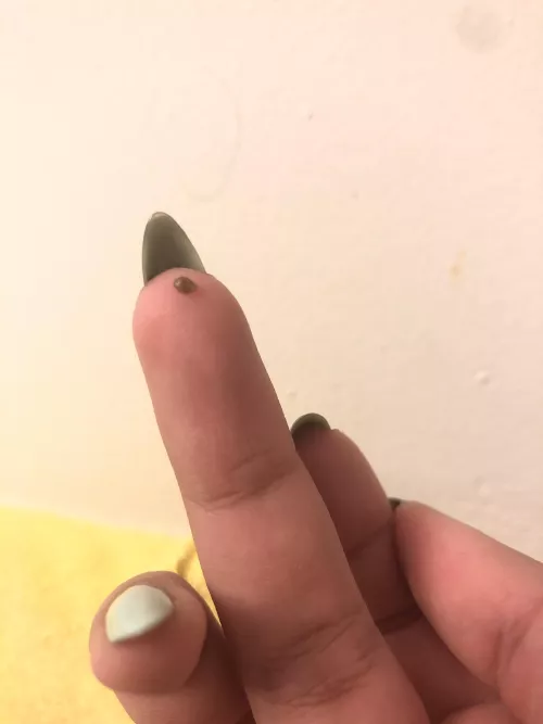 Sesame sized blackhead removed from my buttcheek