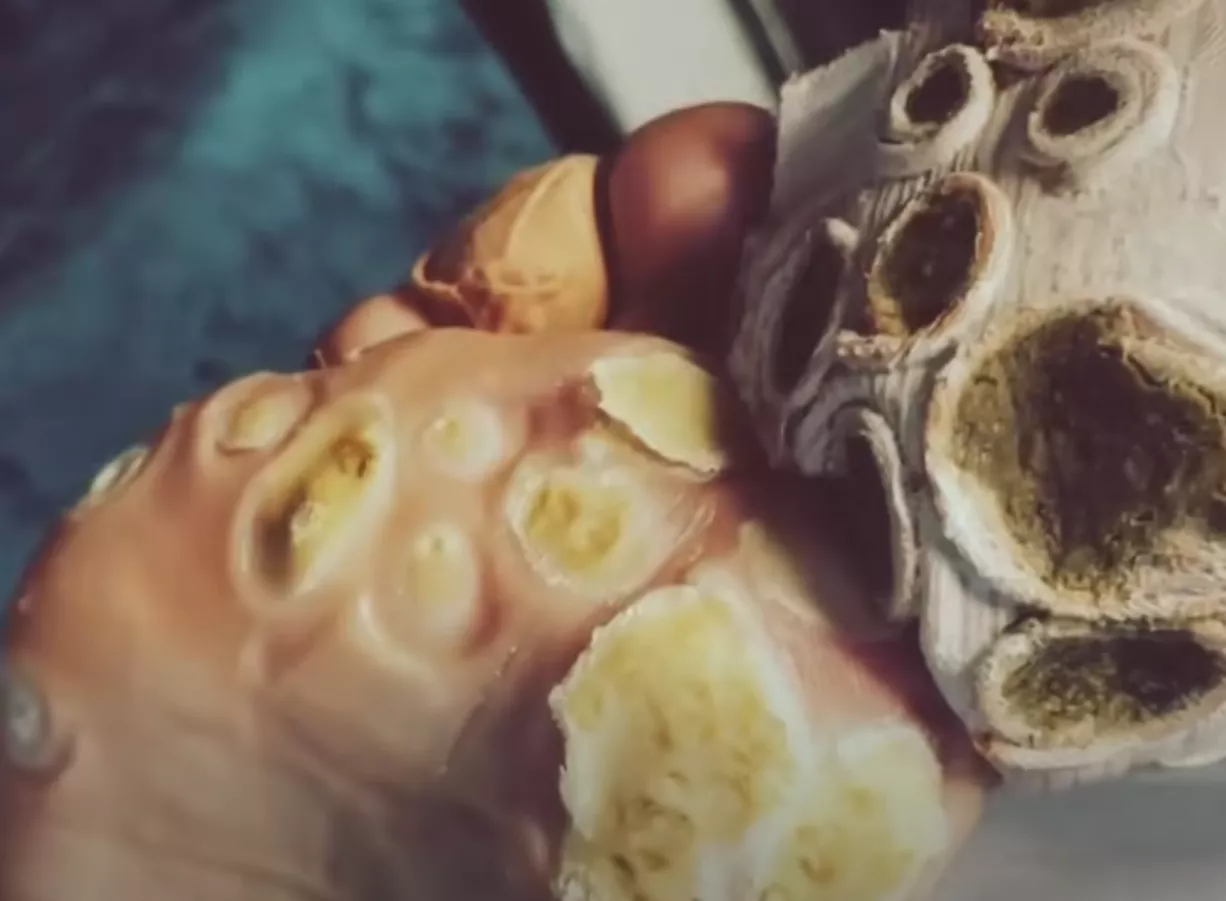 Another plantar wart one for WW - why is he not wearing gloves?! 😱