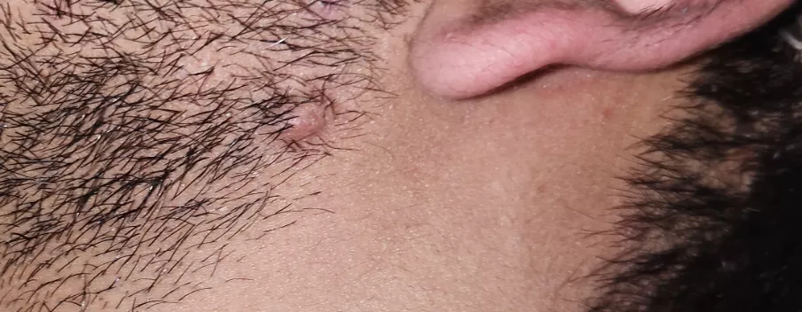 Boil scar?Had a boil almost 8 month back under the ear on the chin area and I have this raised bump now that won't go away. Anyone had this any solutions??