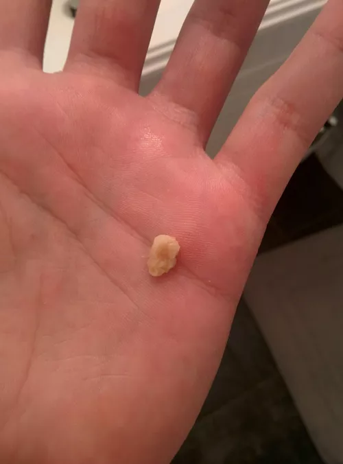 My absolute MONSTER tonsil stone that just came out 🤢
