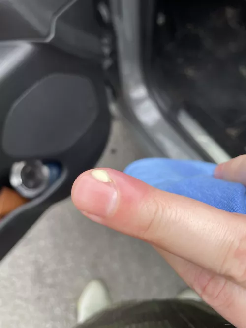 Yoinked a hangnail and it got infected