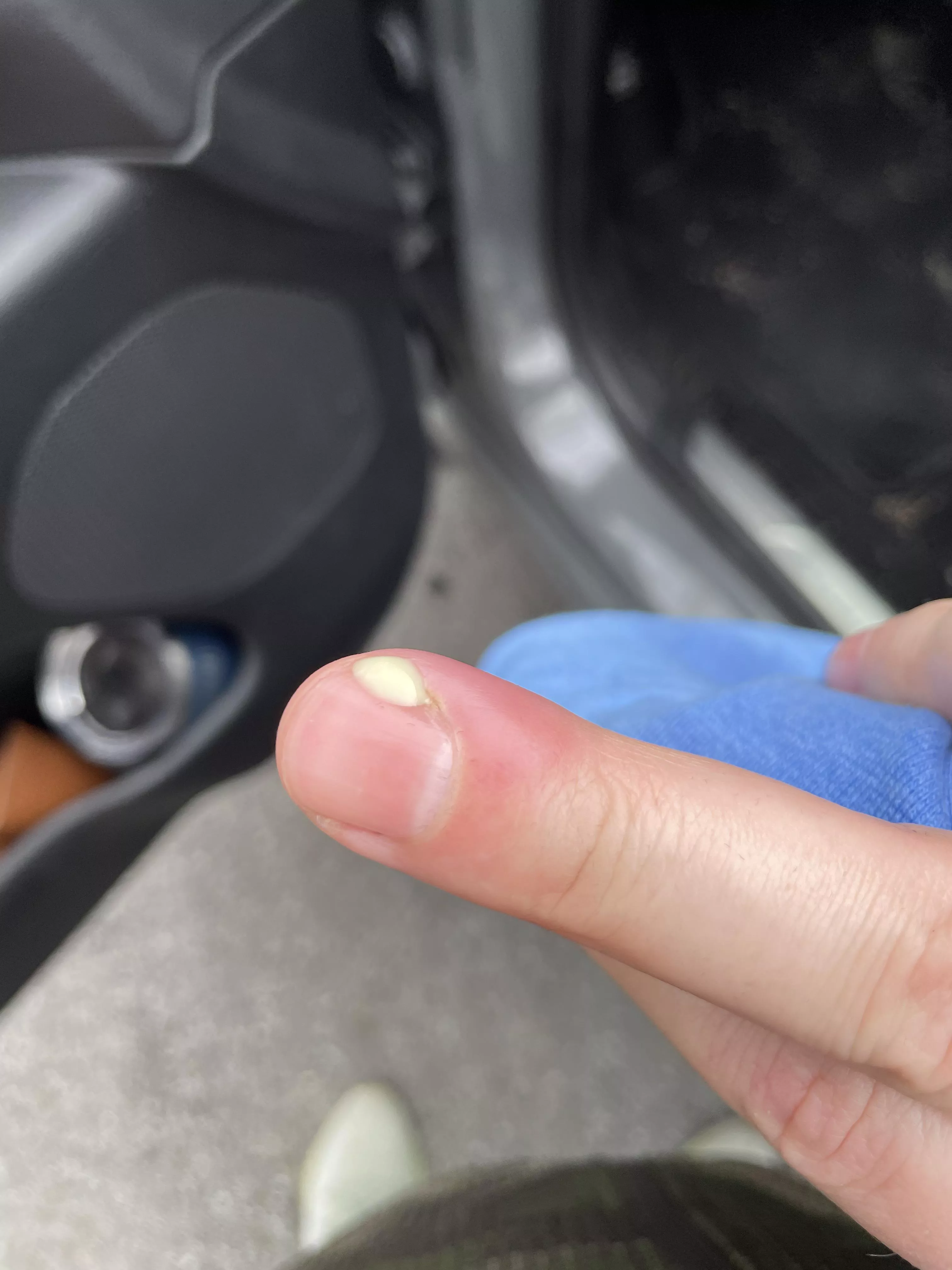 Yoinked a hangnail and it got infected