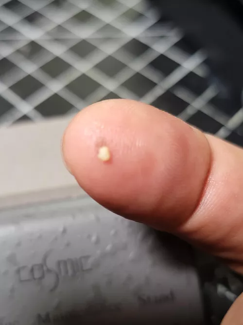 A blurry tonsil stone