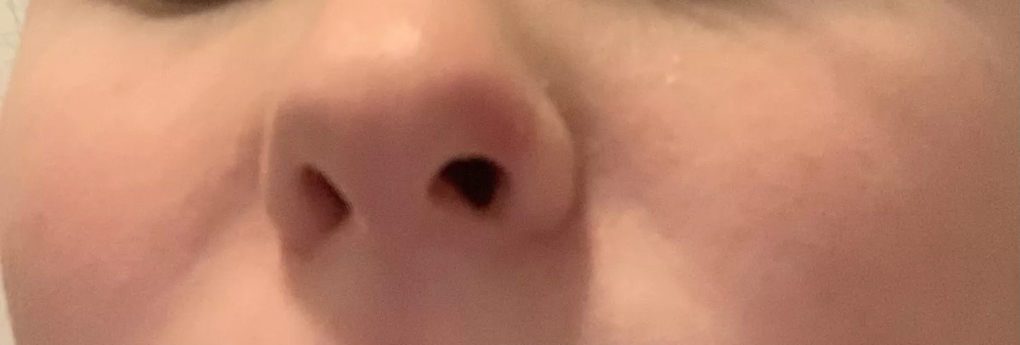 Nose Pimple that came to head on both sides…sent help😫