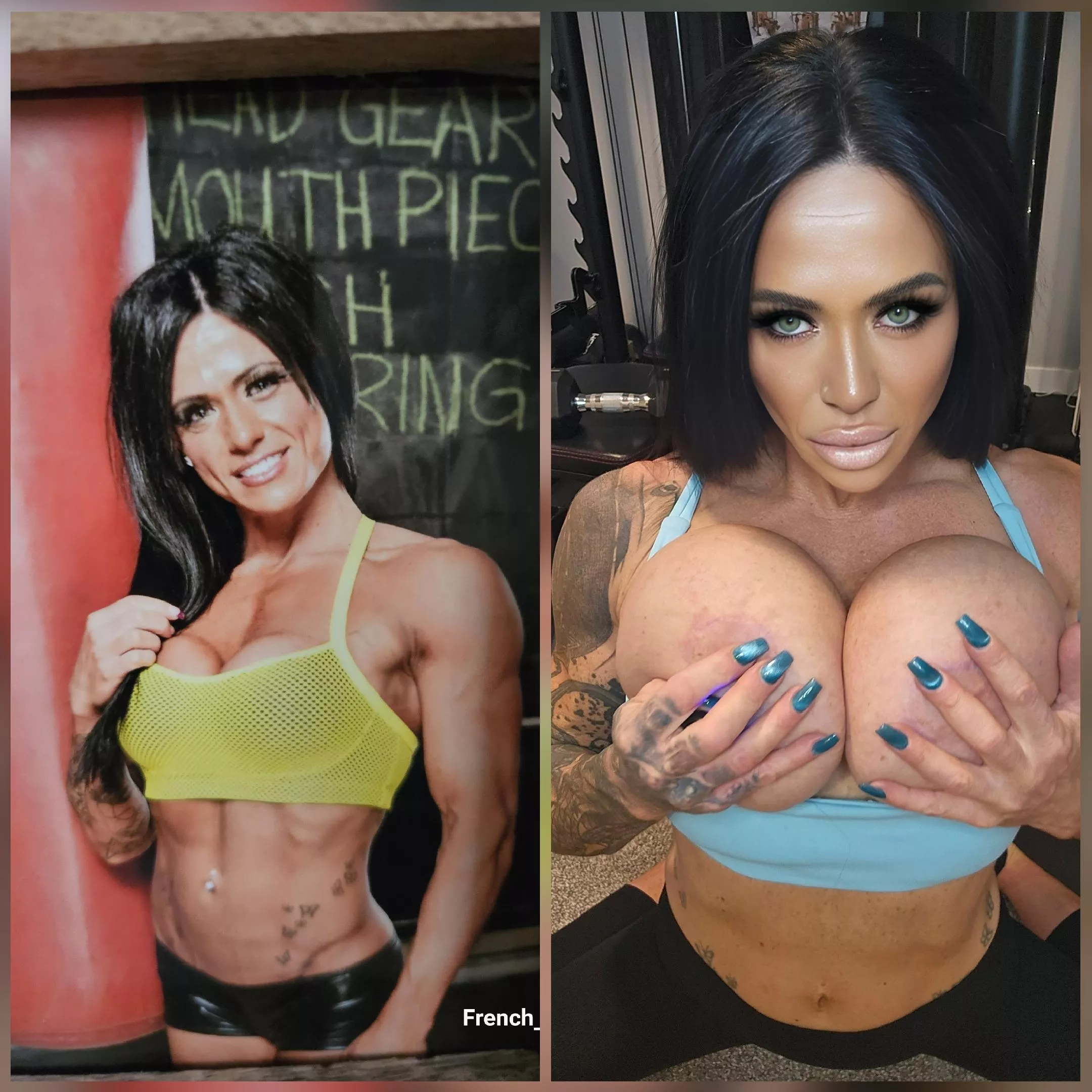 Transformation 375cc to 1250cc lip filler, cheeks and jaw.