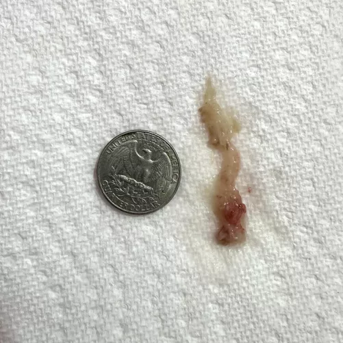 Sneezed huge nasal mucus plug. Been sick for days, such a relief to breathe again