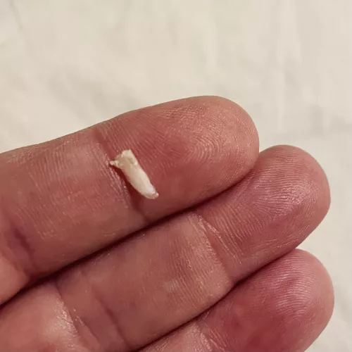 Popped out the extra sliver of toenail tonight