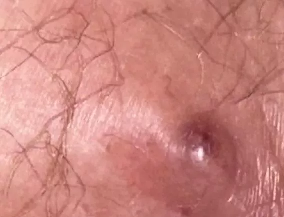 Hemorrhoid or pimple or ingrown oh my!