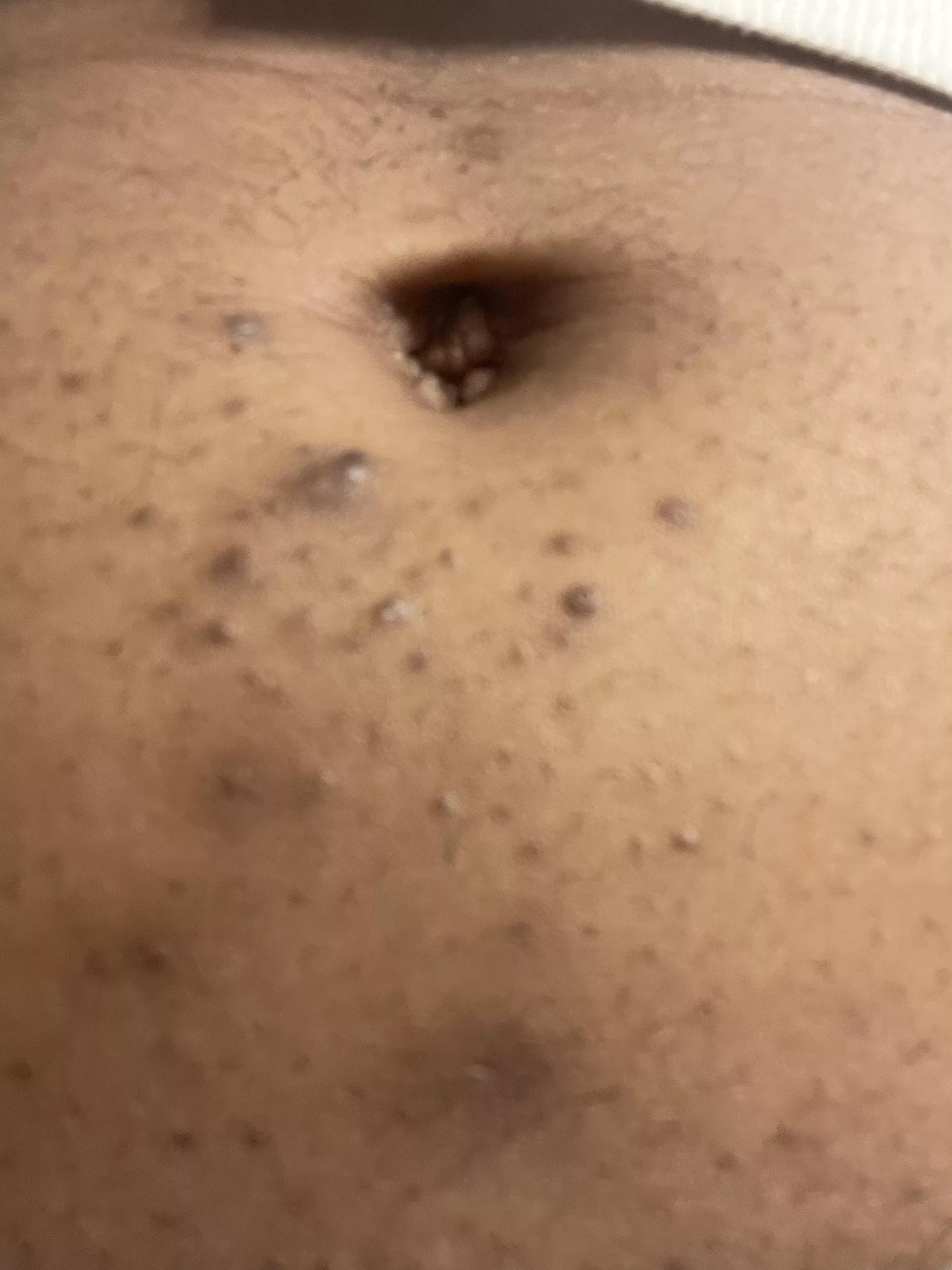 Ingrown hair on my belly button..sometimes puss filled