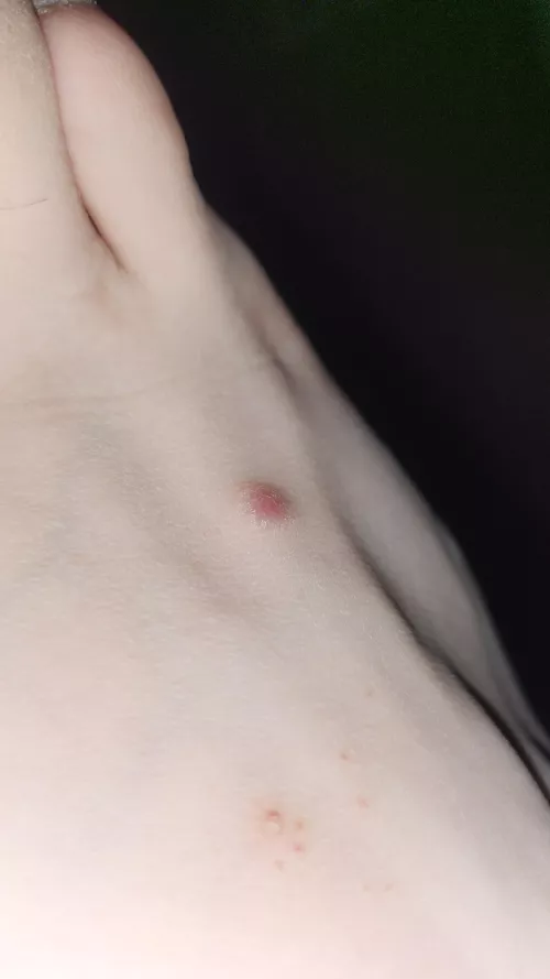 Weird red bump on my foot. What is this!??!?!