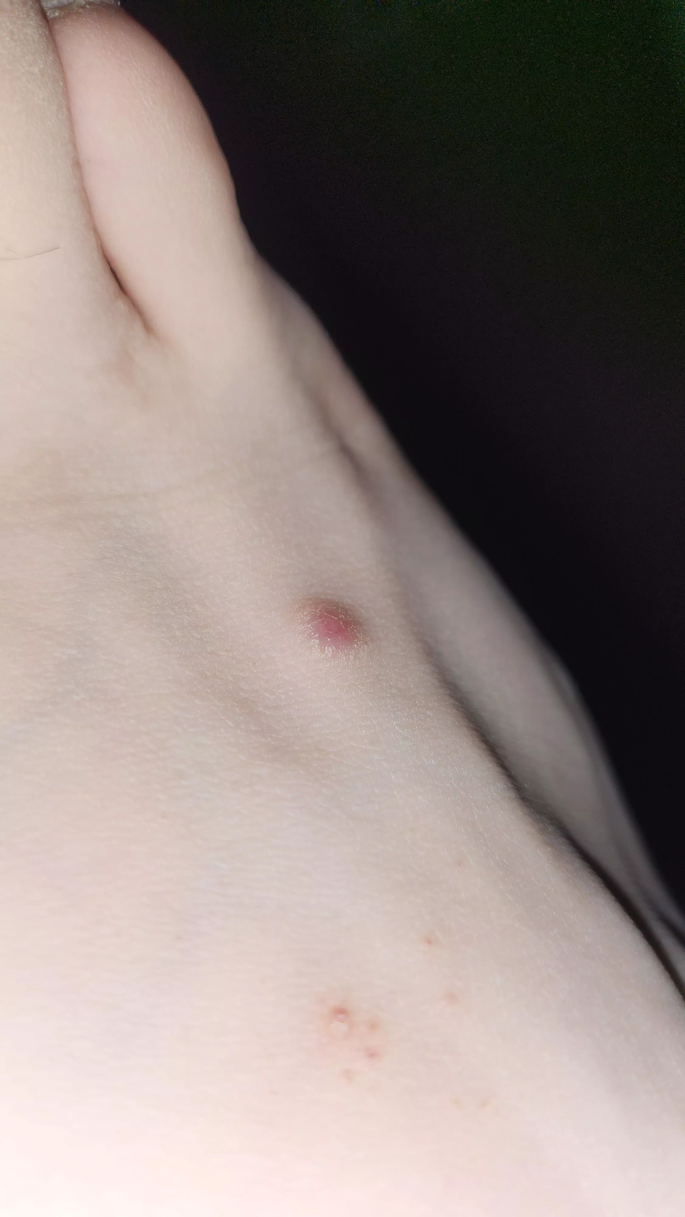Weird red bump on my foot. What is this!??!?!