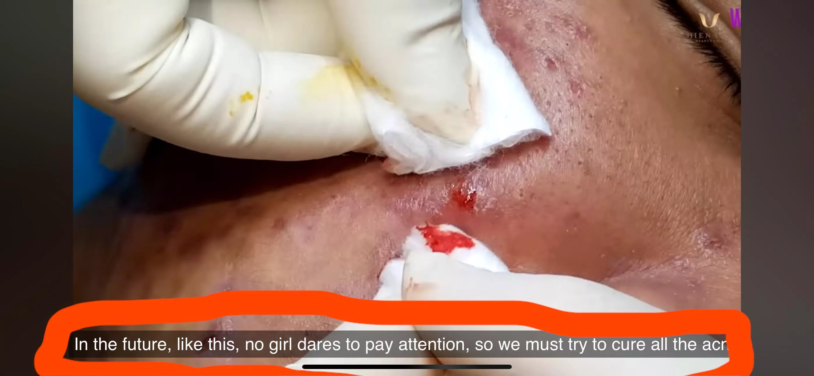 HHV Clinic and the CC commentary is OFF THE CHAIN. 😬. Love the cystic pops, but this tech is ROASTING her client. Like you just said whaaaat to him??