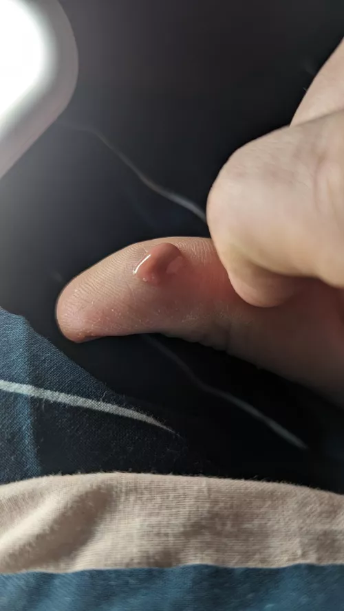 My armpit felt so much better after this mess came out.