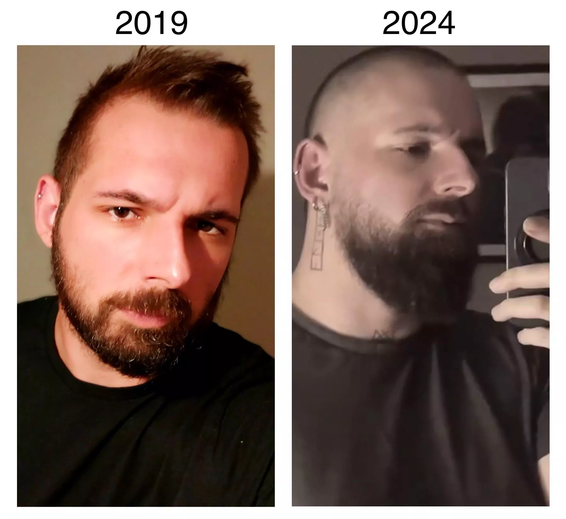 My hair migrated 😂