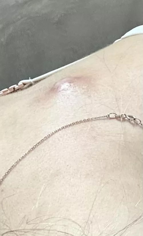 Sebaceous cyst on vacation