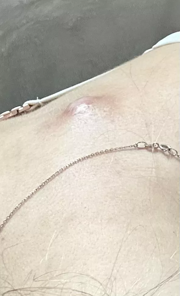 Sebaceous cyst on vacation