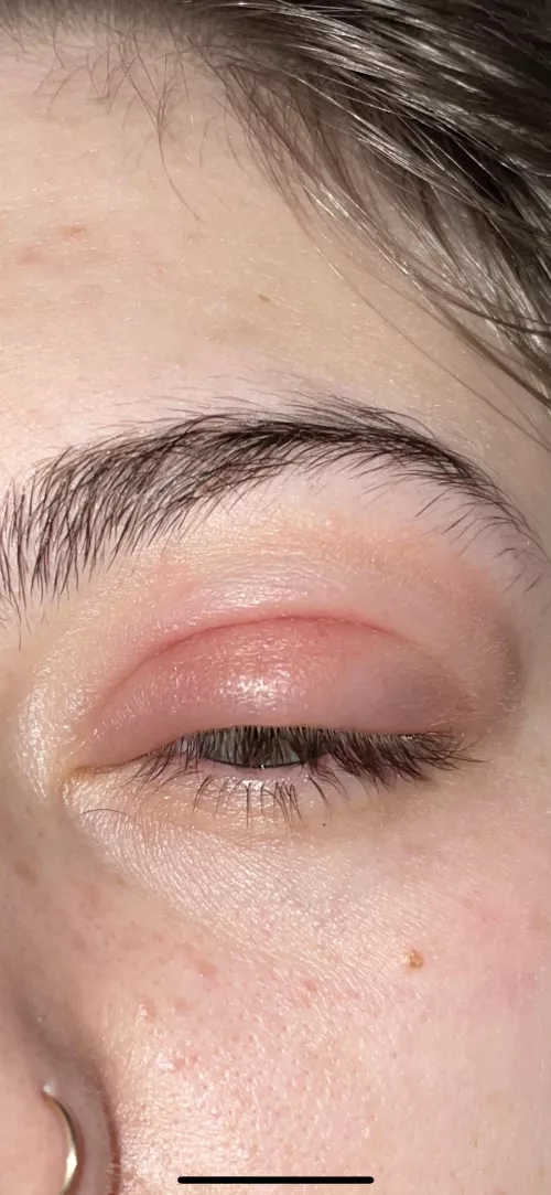 Forbidden pop! 2nd Presepstic cellulitis