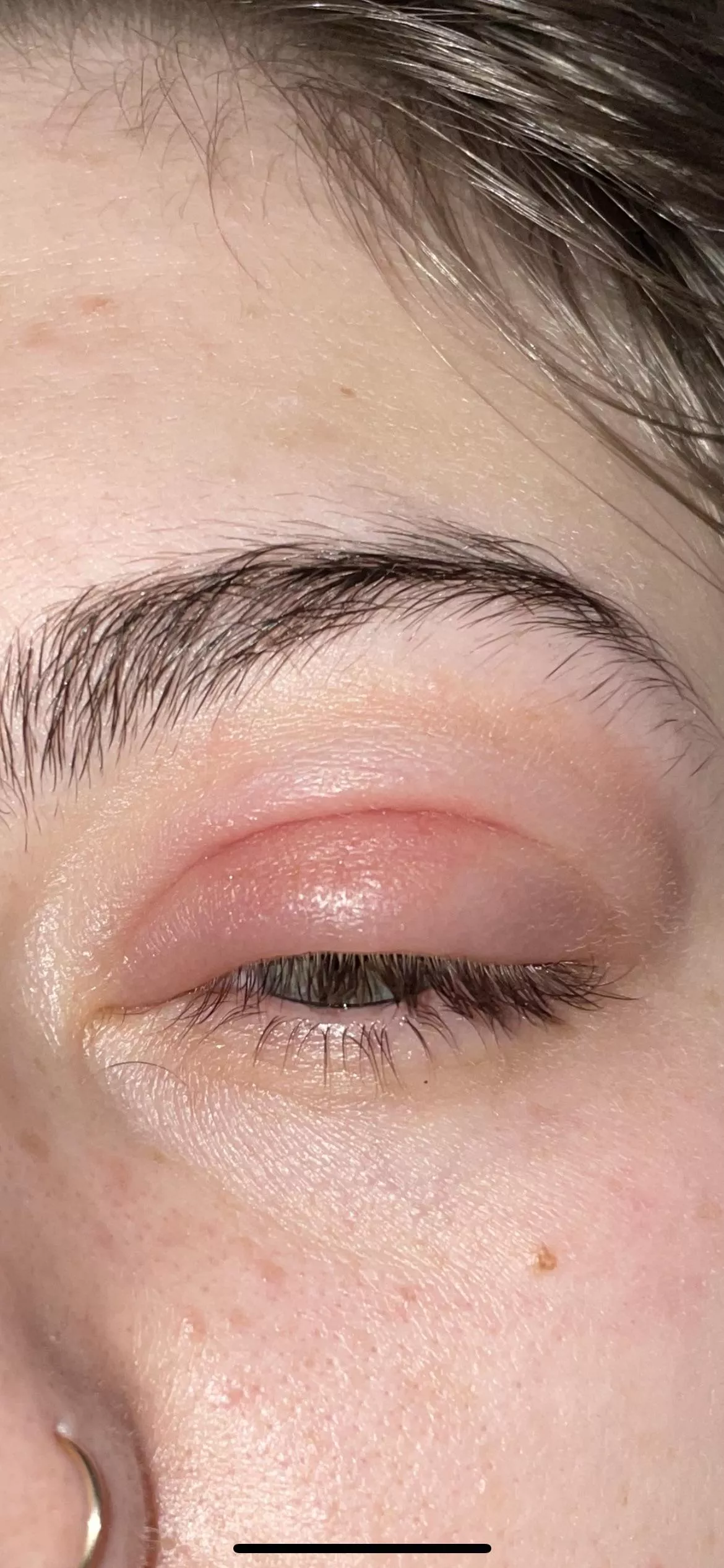 Forbidden pop! 2nd Presepstic cellulitis