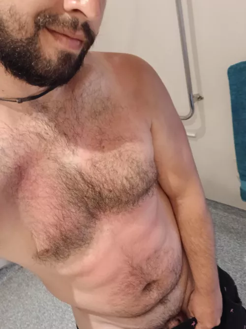 Help wanted: Help me recover from this light sunburn