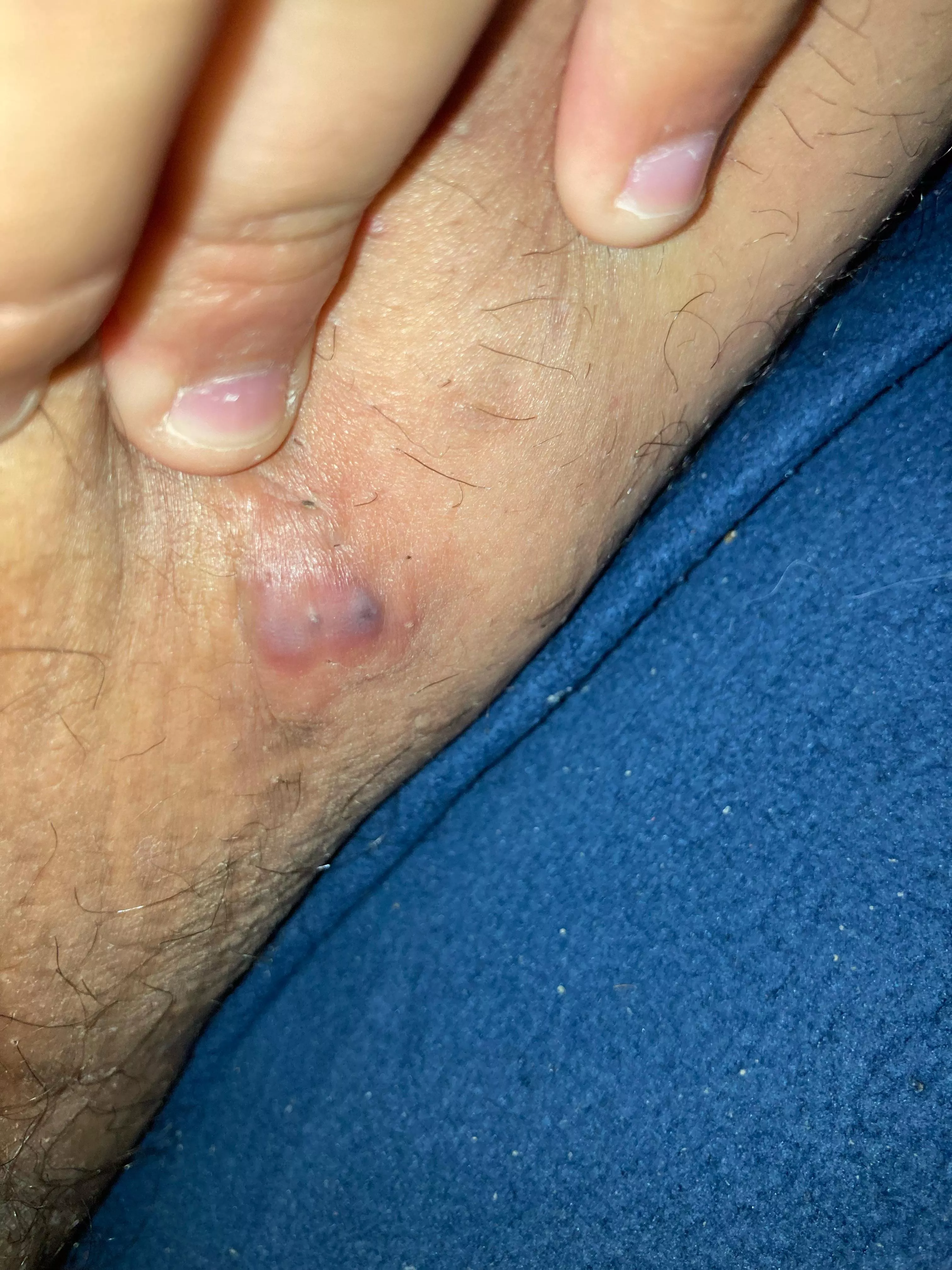 Located in my inner thigh, this thing looks pretty gnarly. (Marked as NSFW for its location.)