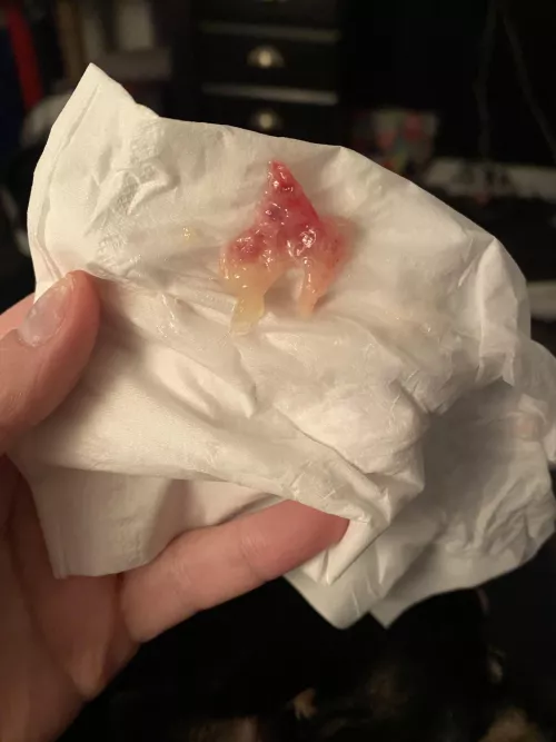 It’s me again! Blew out another polyp (?)