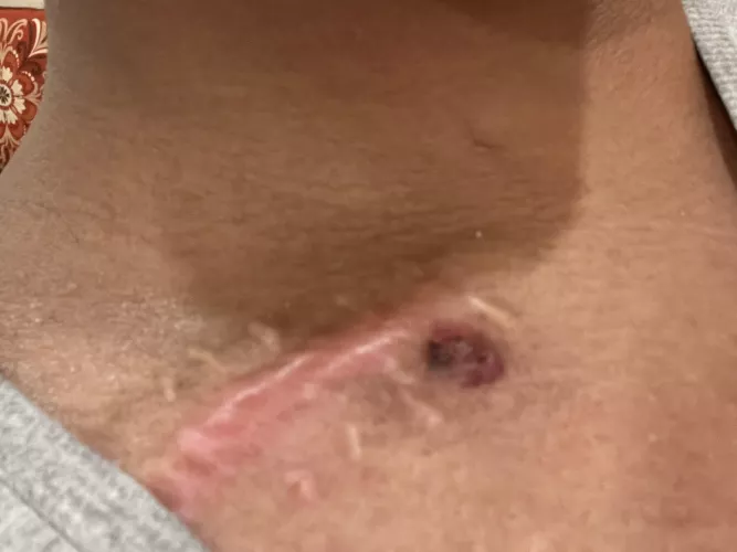 Pimple around surgical scar 5 months later