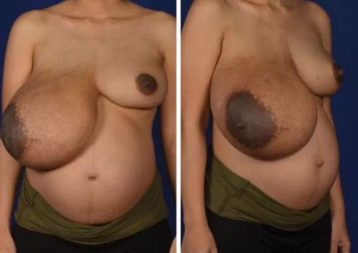 Extremely lopsided pregnant breasts