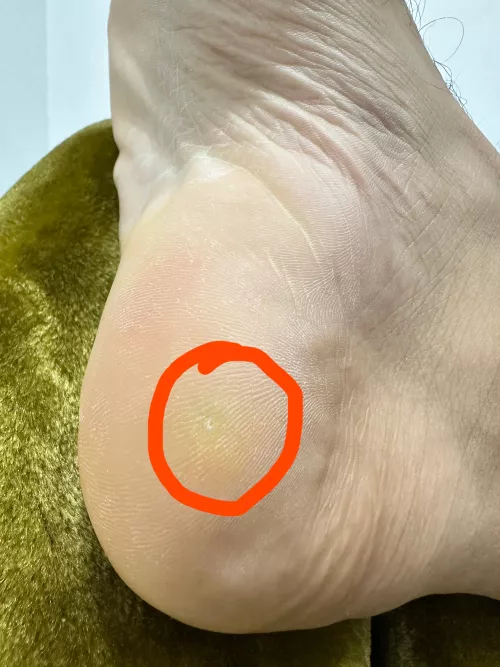 Pimple inside foot from last two weeks