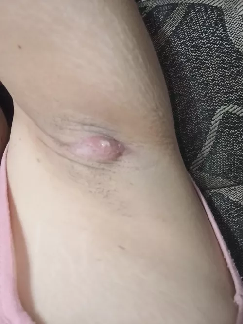 is my armpit boil finally rupturing?