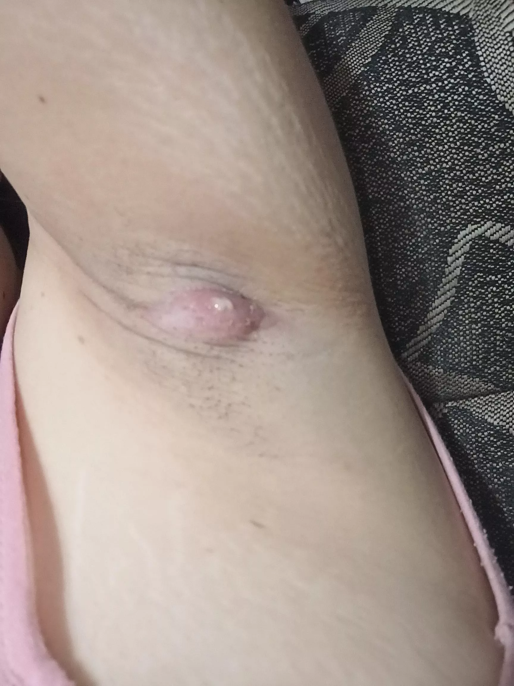 is my armpit boil finally rupturing?
